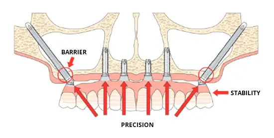 Understanding All-on-4 and All-on-6 Treatments