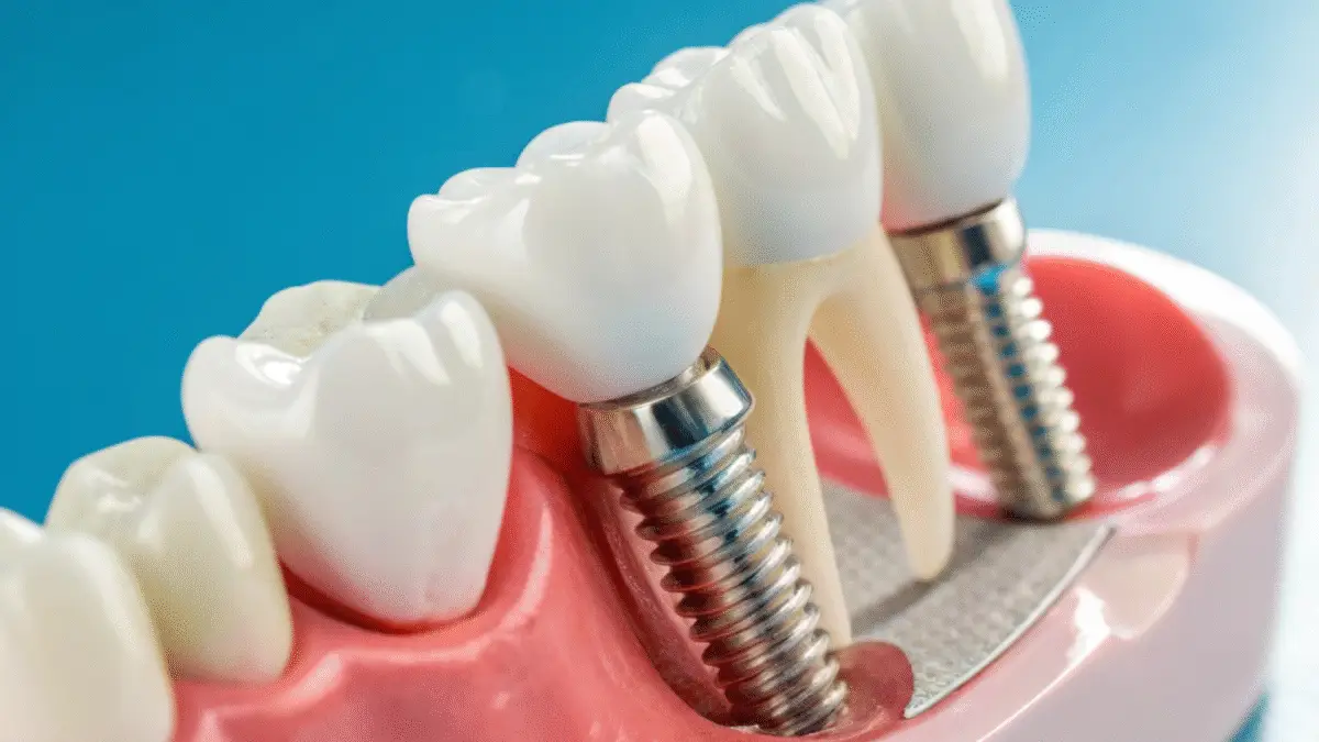 Dental implants