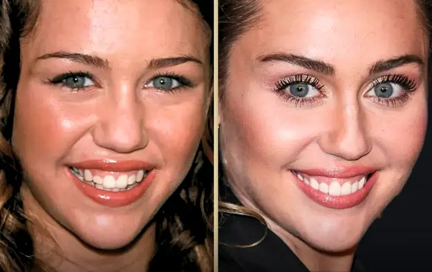 Did Miley Cyrus Get Veneers?