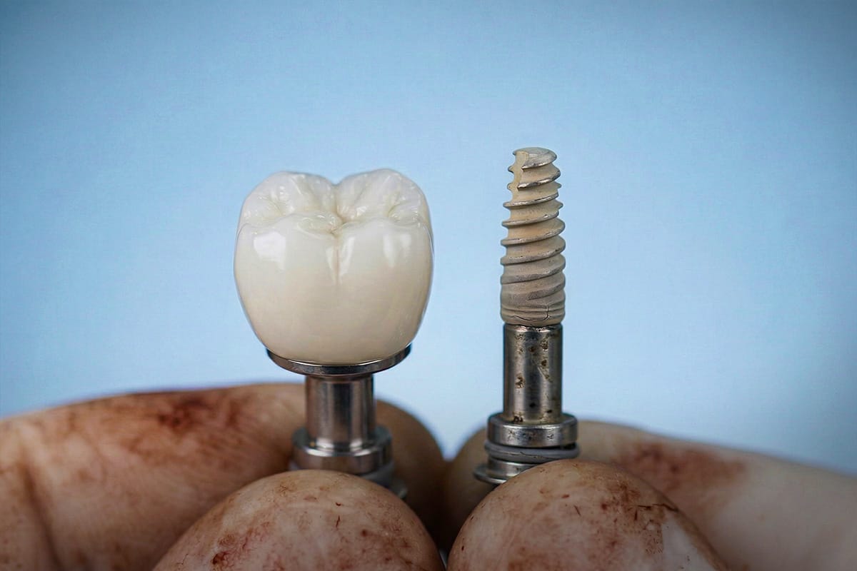 Dental implants